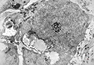 M,12y. | Ewing sarcoma - thorax